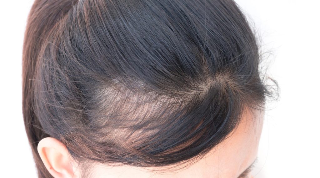 Postpartum Alopecia